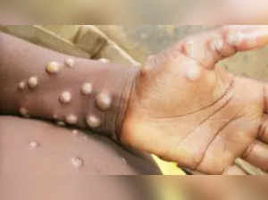 Africa CDC calls for urgent action against concerning spread of mpox