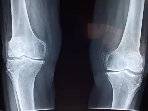 How to maintain good bone health?