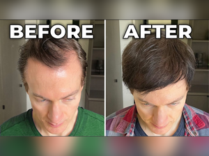 How Bryan Johnson’s Millionaire Mindset Helped Him Reverse Hair Loss