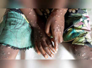 Mpox is not under control in Africa, warns Africa CDC