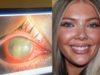 23-year-old woman loses vision after swimming with contact lenses: What lens wearers need to know