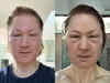 Tech millionaire Bryan Johnson's face ‘blows up’ after anti-ageing experiment goes horribly wrong. See pics