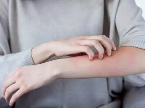 Sunburn relief