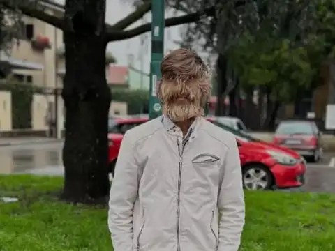 Understanding Hypertrichosis or 'Werewolf Syndrome'