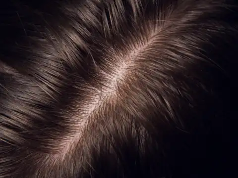 Scalp Irritation