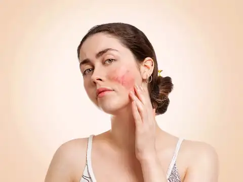 Eczema or Skin Inflammation