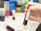 Lenacapavir HIV shot approved in US may enter Canada by 2026; just two injection:Image