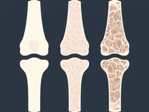 What is osteoporosis?