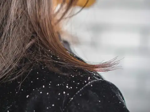 Dandruff-prone scalp