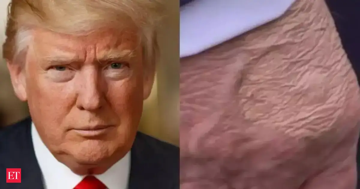 Donald Trump health update: What is U.S. President's condition after chronic venous insufficiency diagnosis? Is it life threatening?