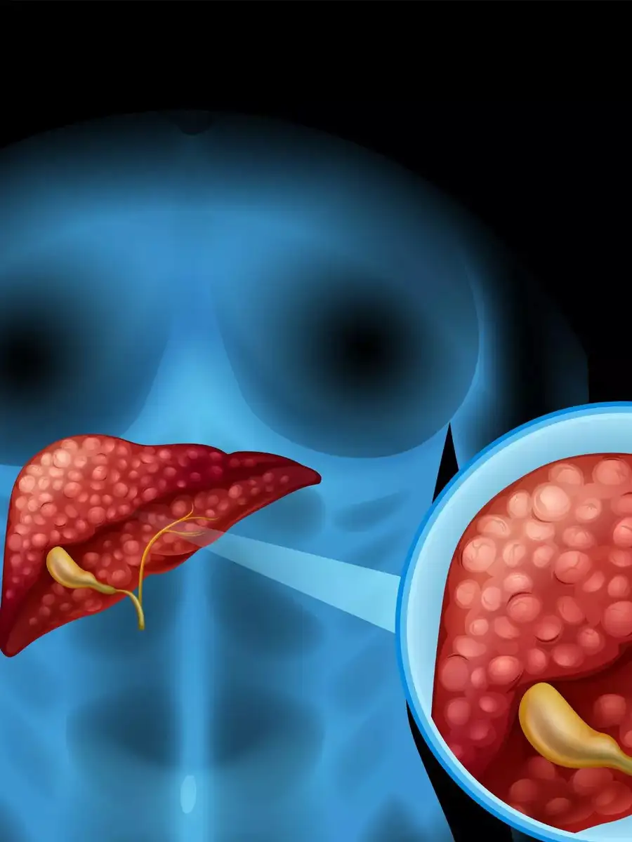9 natural ways to repair fatty liver naturally | EconomicTimes