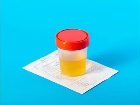  Dark or Cloudy Urine