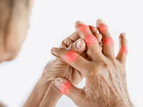 Persistent Joint Swelling & Redness