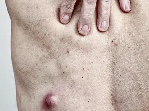 A Lump or Mass
