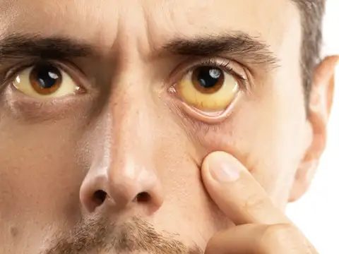 Jaundice