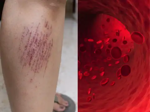 Easy bruising or bleeding