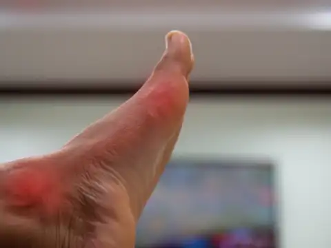 Frequent Gout Attacks
