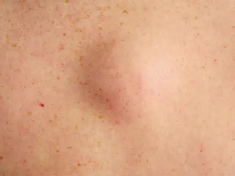 Swelling or lumps