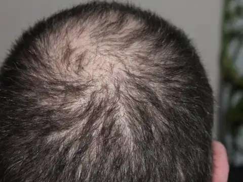 Styling/scalp damage &mdash; what to eat for it