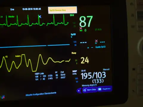 Irregular heartbeat