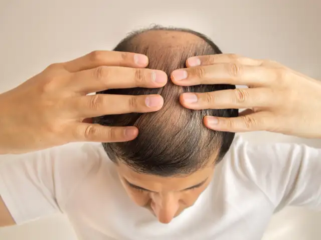 Hair fall trouble