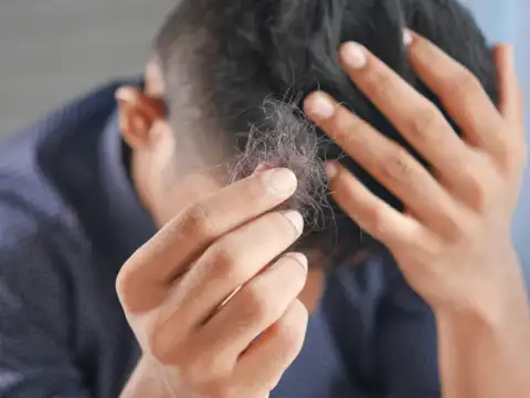 Why men face hair fall 