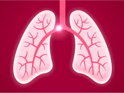  Clots in Lungs (Pulmonary Embolism)