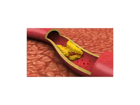 Clots in Arteries