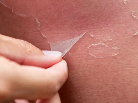 Dry, Flaky Skin: Thyroid Troubles?