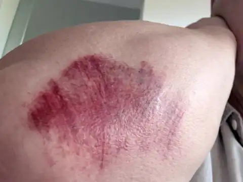 Easy bruisi​ng and bleeding