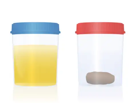 Dark urine and pale stools