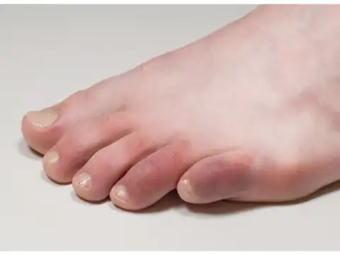 Foot Colour Variations