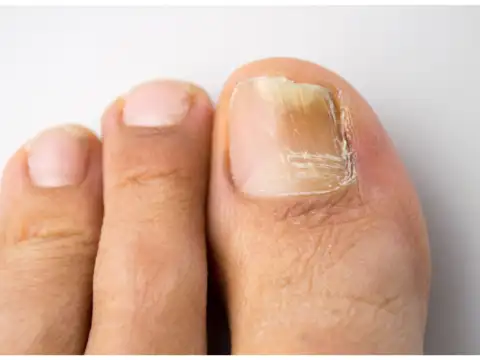  Pale or Discoloured Feet