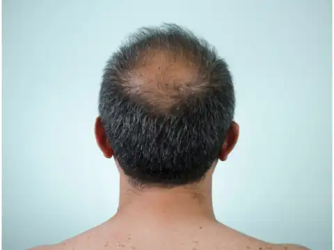  In your 60s and beyond: Minimal regrowth, only preservation