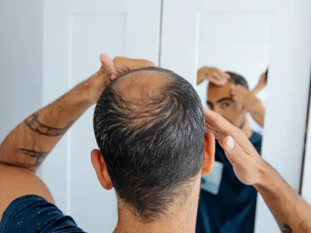 Hair Transplantation for Hair Loss in 60s and 70s: Features and Effectiveness of Hair Loss Medications