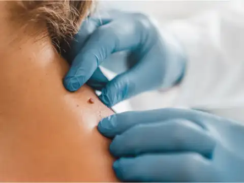 Skin changes or non-healing sores