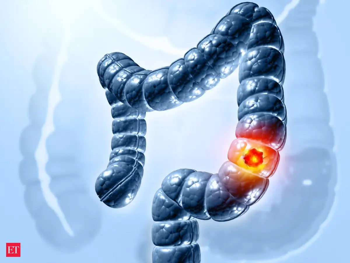 5 hidden colon cancer signs that appear early and often without any ...