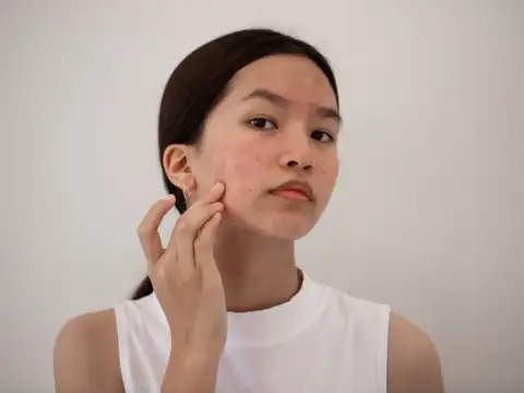 Reduces Acne & Inflammation