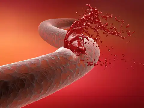 Artery wall tearing (SCAD&mdash;spontaneous coronary artery dissection)