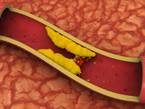 Regular artery blockage (cholesterol buildup)
