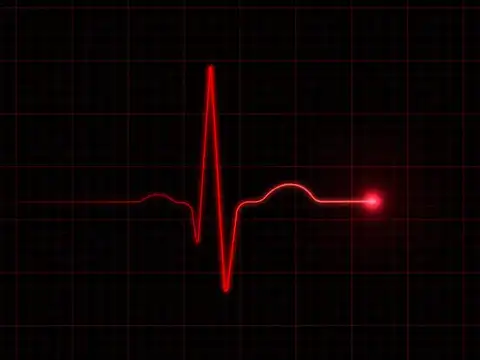  Irregular heartbeat or palpitations