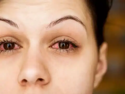 Retinal bleeding or &ldquo;blood and thunder&rdquo; appearance