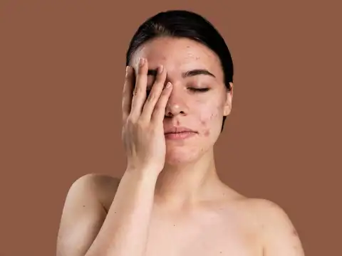 Pigmentation