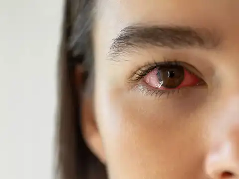  Risk 3: infectious conjunctivitis susceptibility