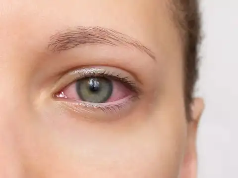  Risk 2: allergic conjunctivitis flare-ups