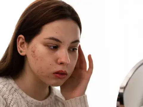 Acne or itchy skin