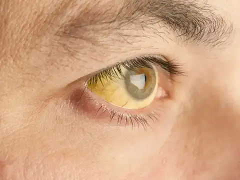  Painless jaundice (yellow eyes/skin)