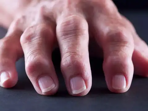 Finger clubbing (nails and fingertips)