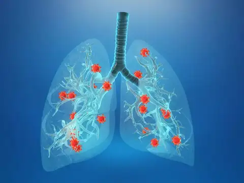  Lung infections (colds, pneumonia getting worse)