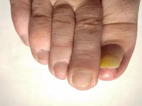  Yellow nail syndrome (thick, yellow, slow-growing)
